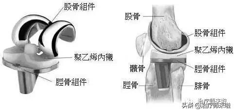 膝关节置换术后康复病历模板,做了膝关节置换术后康复视频