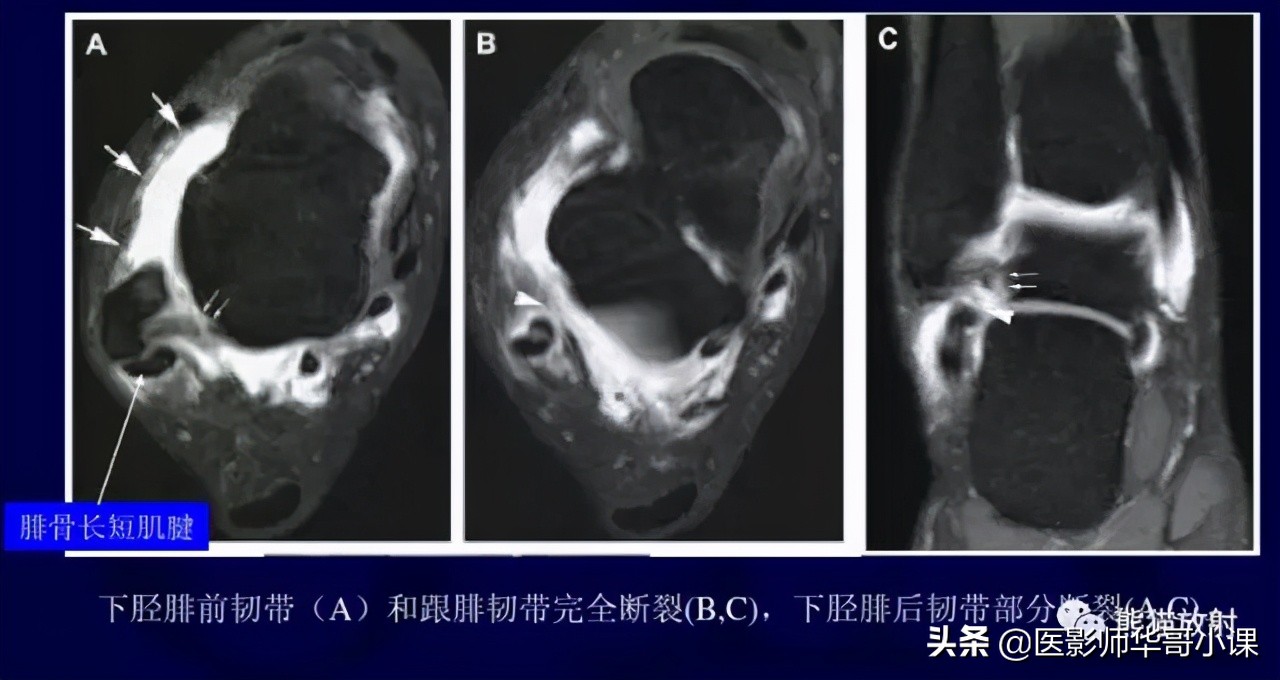 踝关节解剖视频课,解剖学韧带分布图