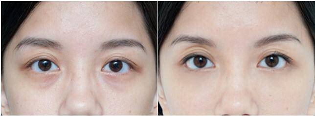 眼部持续温热有好处吗,眼部如何保持清澈