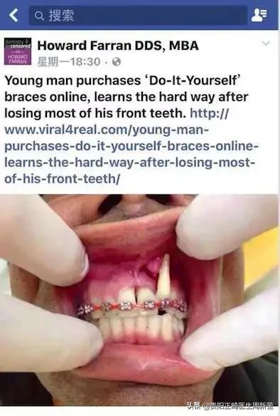 隐形矫正5000多的有哪些套路,隐形矫正说一年就能见效果靠谱吗