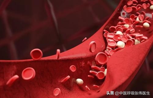 肺动脉栓塞怎么预防,肺动脉血栓栓塞解剖图