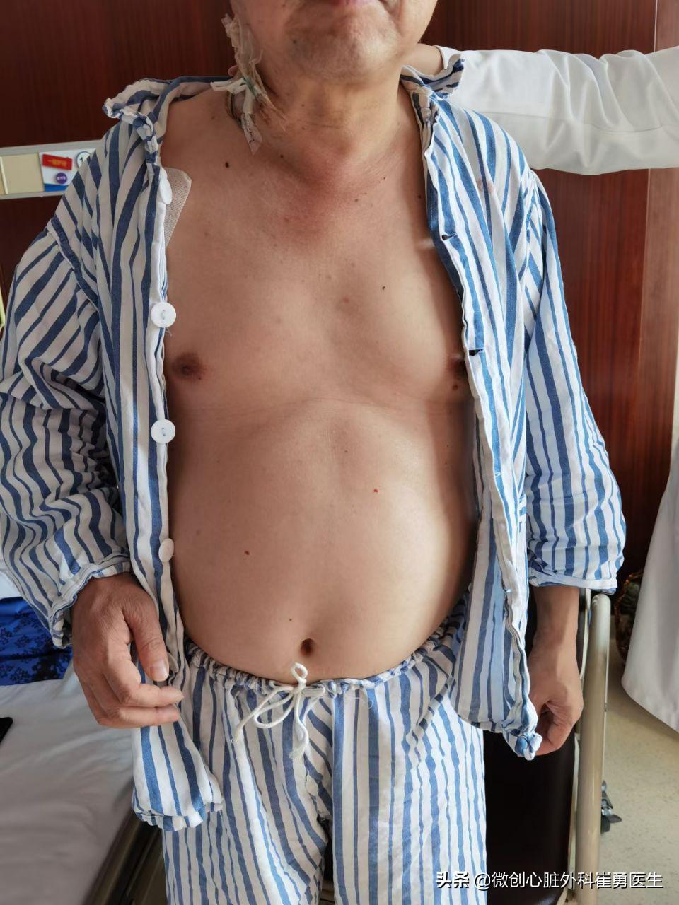 浙江省人民医院做心脏手术如何,浙江人民医院微创心脏手术