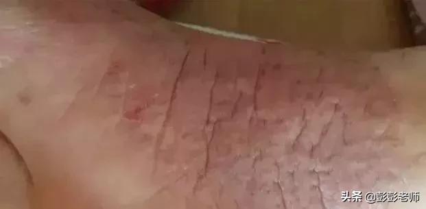 脚后跟干裂怎么快速消除小窍门,脚后跟干裂一招教你去除