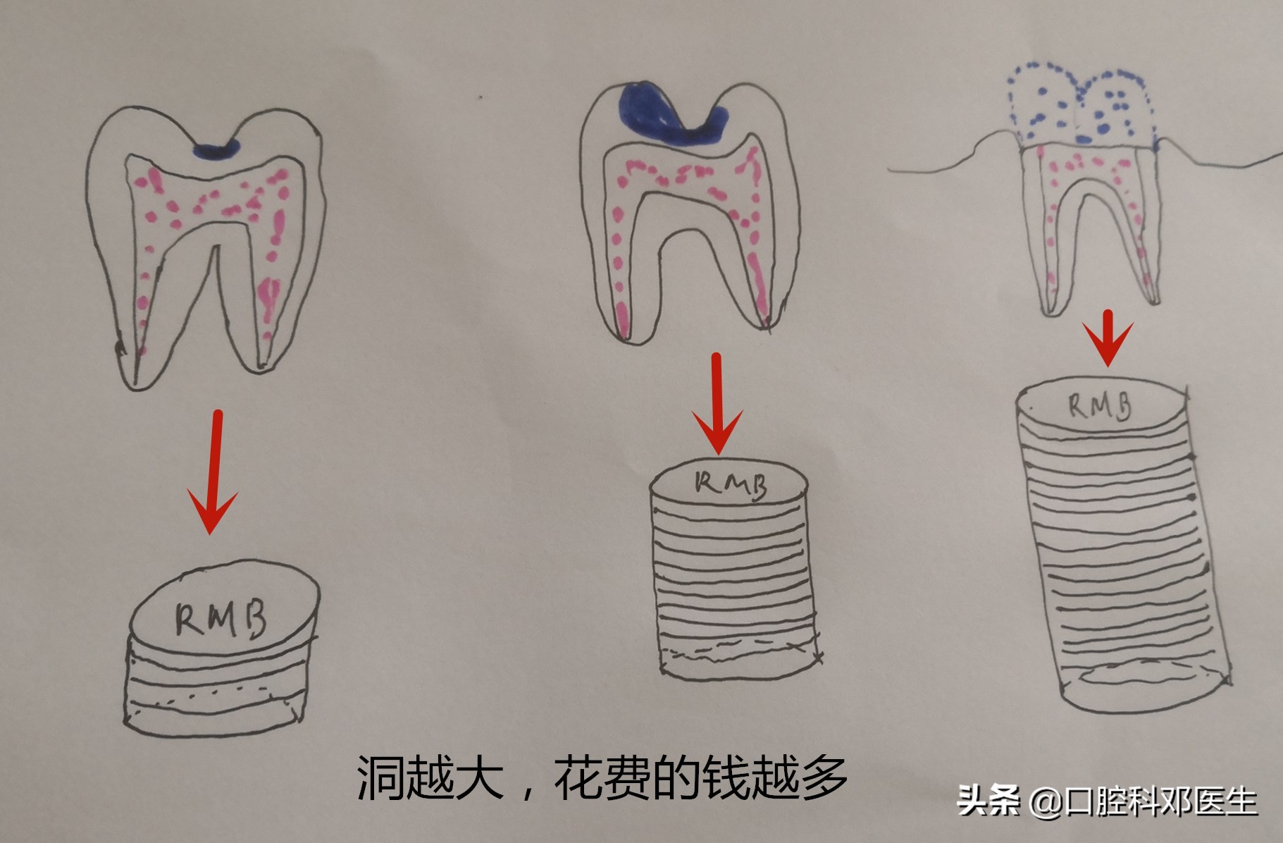 虫牙不及时补有什么后果,虫牙不治疗直接补能管多久
