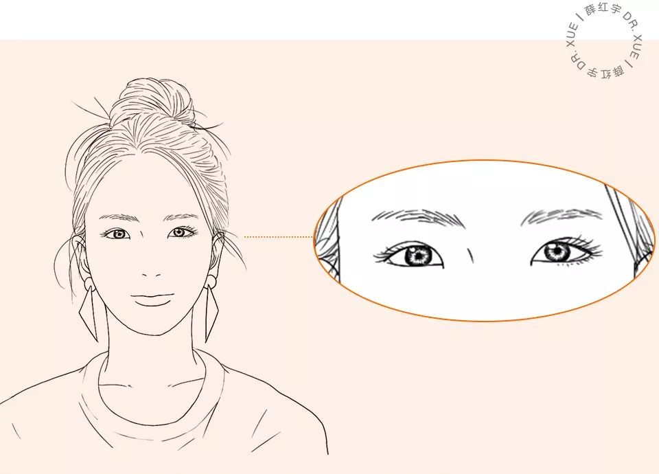 从美术角度谈眯眯眼,开内眼角传统术式