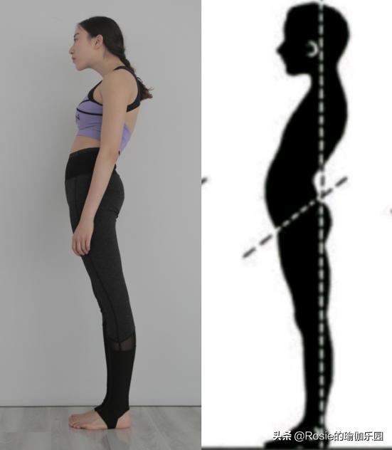 肋骨外翻怎么改善回来,肋骨外翻改善法