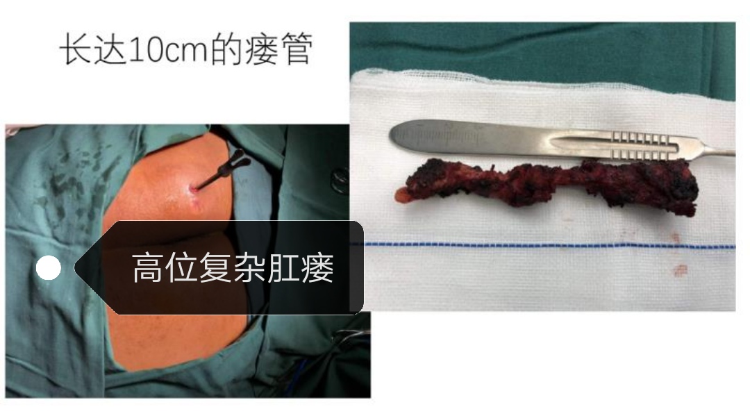 肛瘘内口愈合了还要不要做手术,肛瘘手术当天要不要人照顾