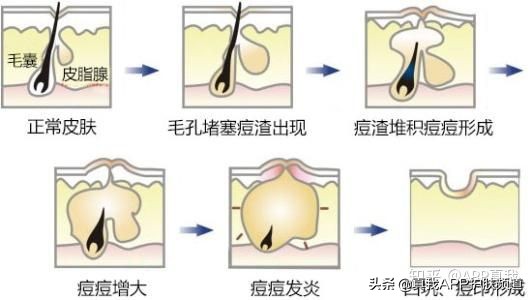祛痘印效果最佳的产品是什么,祛痘印效果好的产品是什么