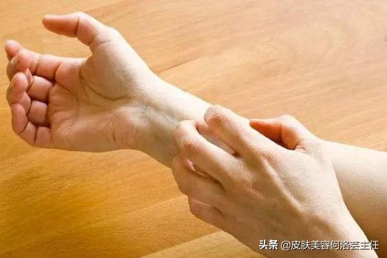 慢性荨麻疹治好了还需要忌口吗,麻疹怎么解释