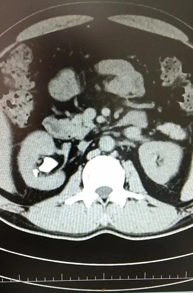 输尿管软镜碎石术安全么,输尿管软镜碎石术难受吗