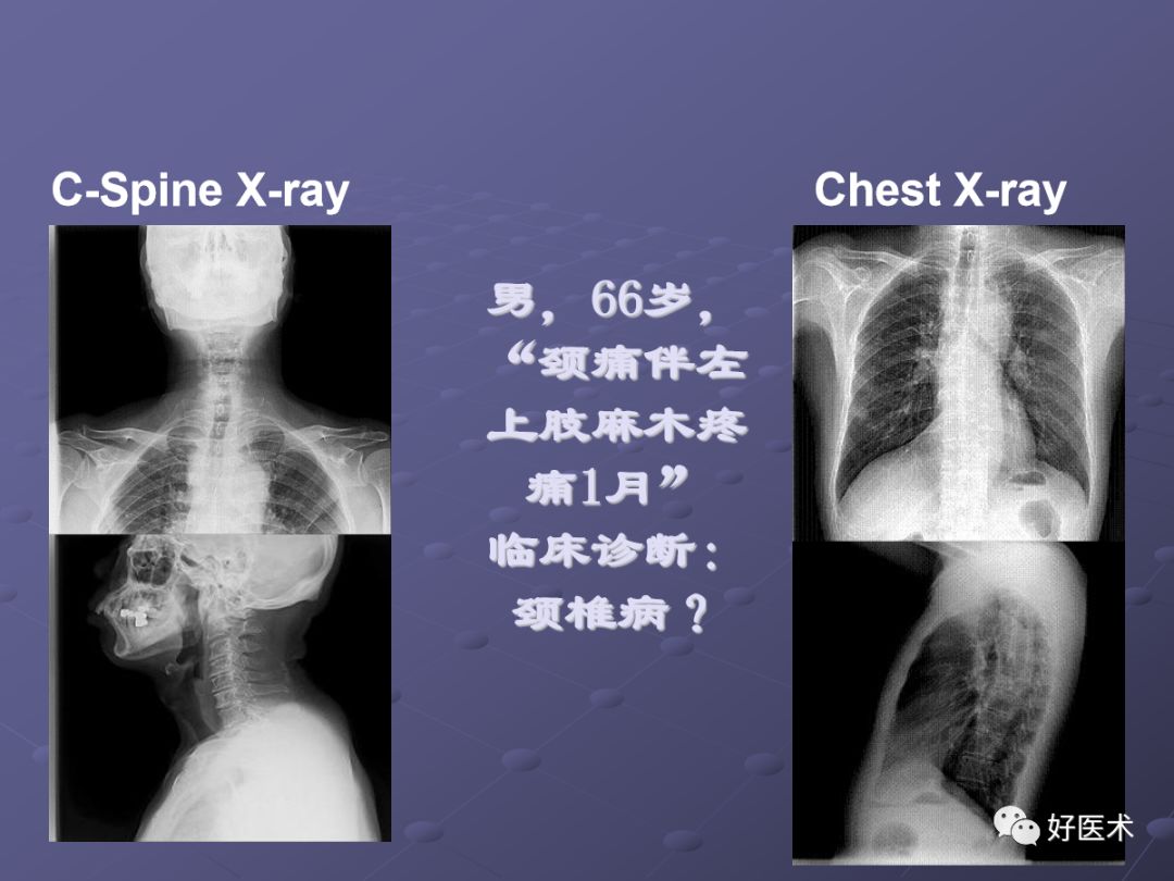 脊柱mri有哪些特点,乳腺疾病的mri诊断及鉴别