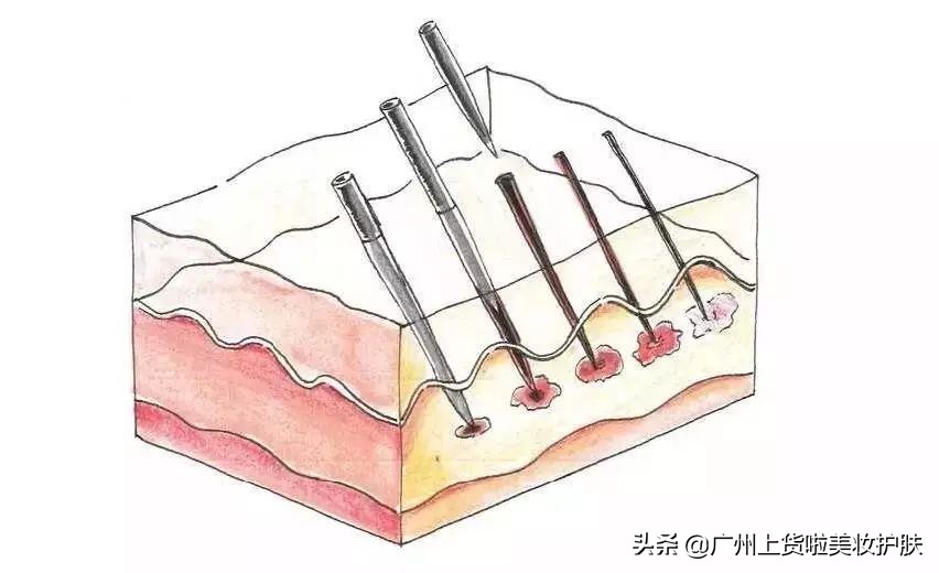 美容微针与滚针的区别在哪,最新技术的微针