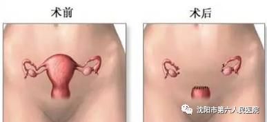 沈阳子宫腺肌瘤最好治疗方法,沈阳市做子宫肌瘤哪个医院好