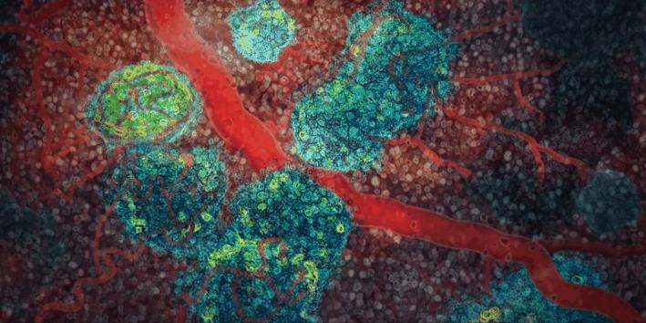 胰岛素是如何导致糖尿病的,胰岛素增多为什么会导致糖尿病