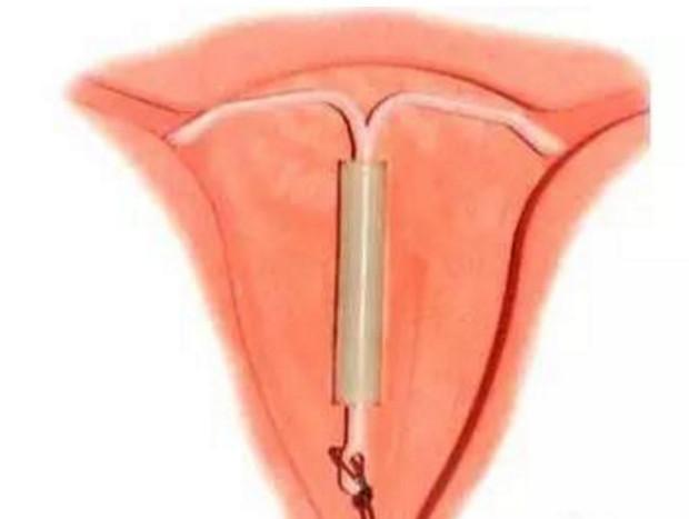 取环备孕需要准备什么,取环备孕注意什么