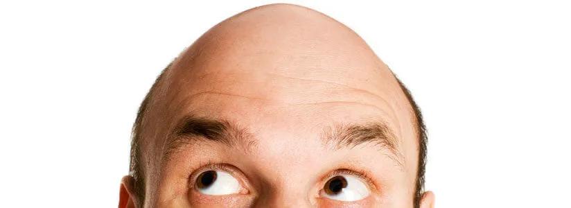 米诺地尔治疗脱发成功案例 (米诺地尔治疗脱发的正确使用方法)