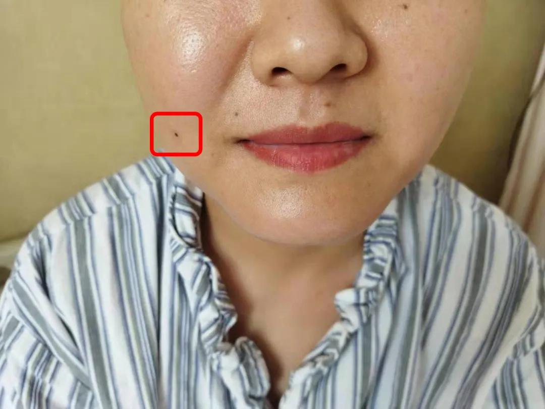 北医三院神经外科采用智能机器人微创球囊压迫术，为复杂三叉神经痛患者解除疼痛