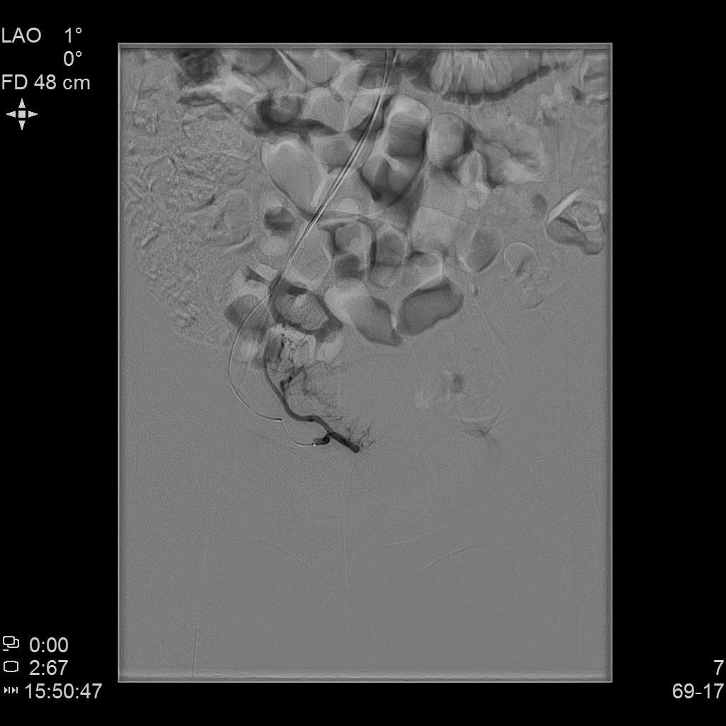 子宫腺肌症介入栓塞全国哪里好,子宫腺肌症介入栓塞治疗报销吗