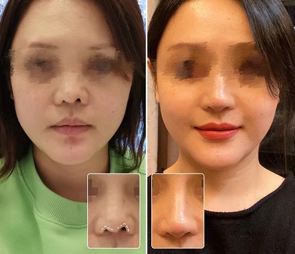 余文林鼻子矫正,余文林唇裂整形修复术