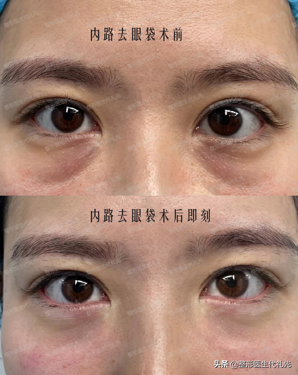 祛眼袋十问十答,提眉祛眼袋泪沟脂肪填充后