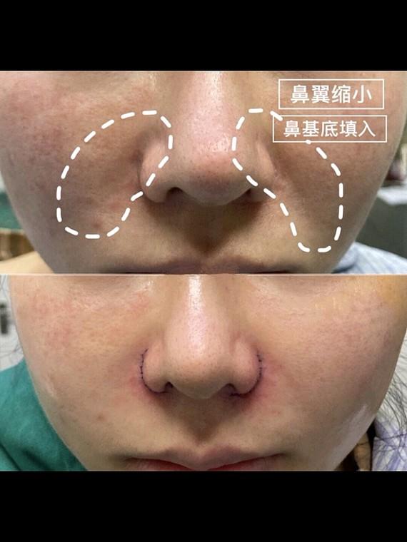 鼻基底填充好还是假体好,为什么垫鼻子要用肋骨