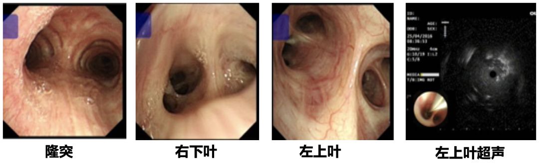 抗感染治疗后效果欠佳，感染非感染？TBLB和肺穿刺病理有哪些提示