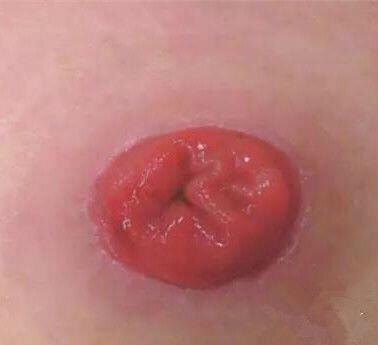 肠造口手术多久可以出院,肠造口的病人出院饮食