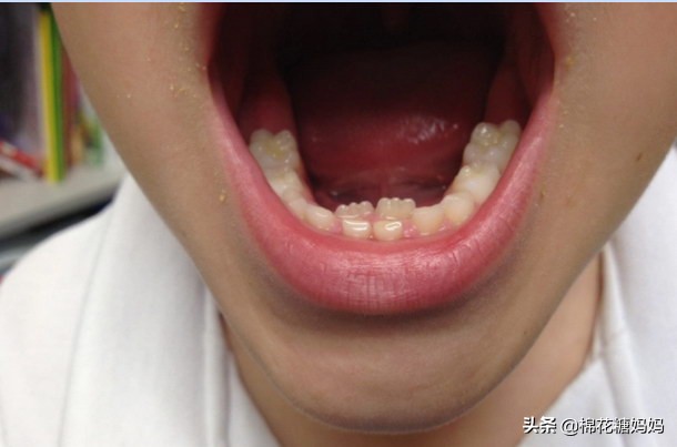 儿童双排牙的危害有多大,孩子长了双排牙该怎么矫正