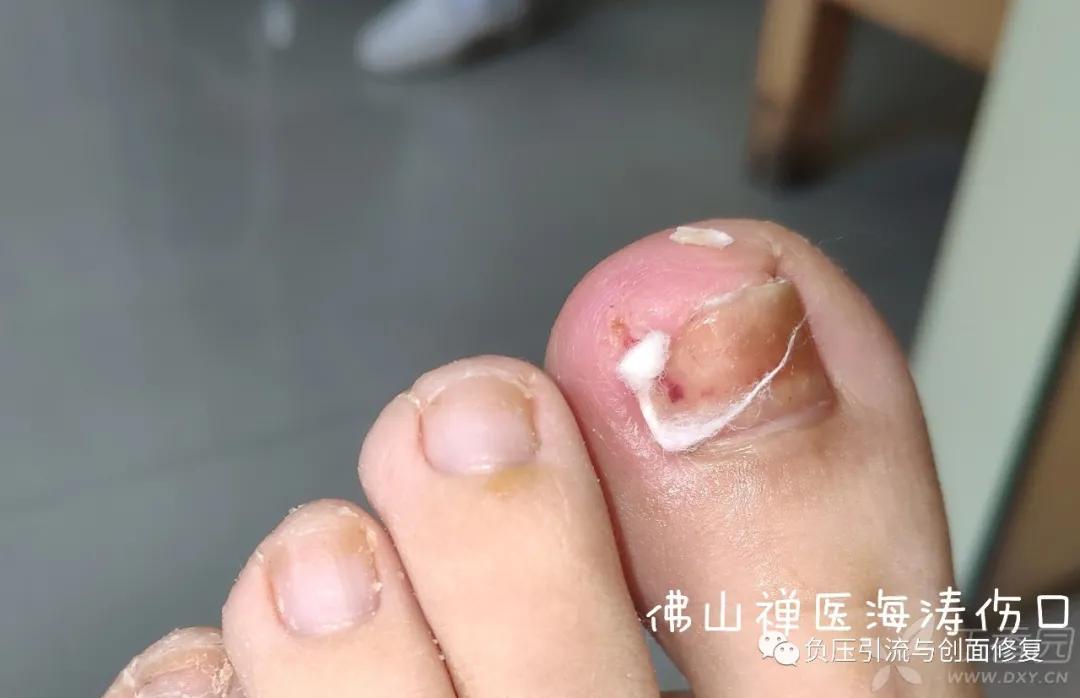 自己剪掉甲沟炎肉芽自己会消掉吗,甲沟炎拔甲后复发的几率多大