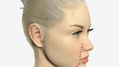 40多岁的人最适合做的除皱项目,目前国内最好的除皱方法是什么