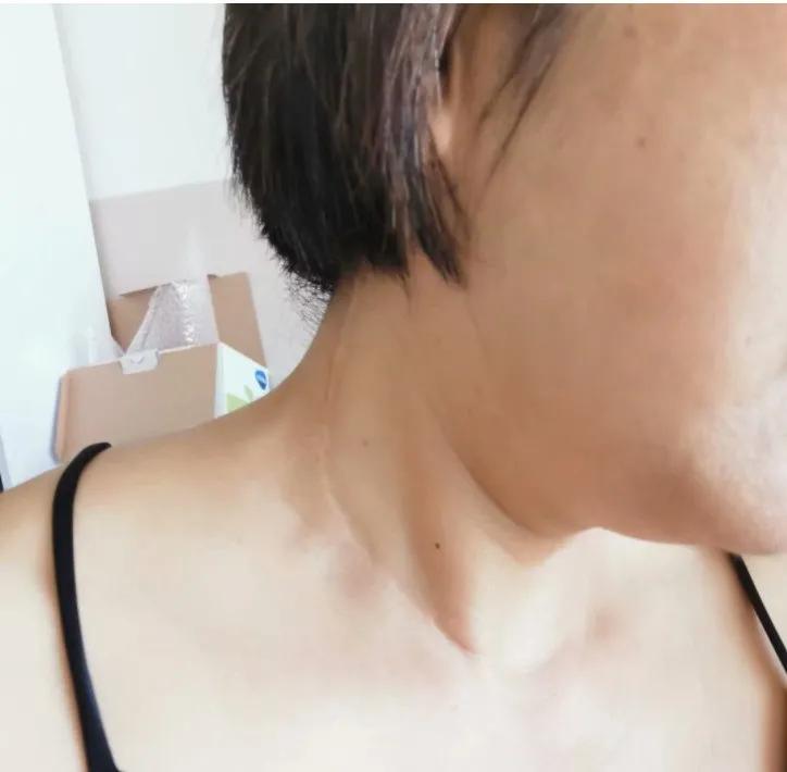 甲癌术后10年与病友分享,甲友心声最新消息