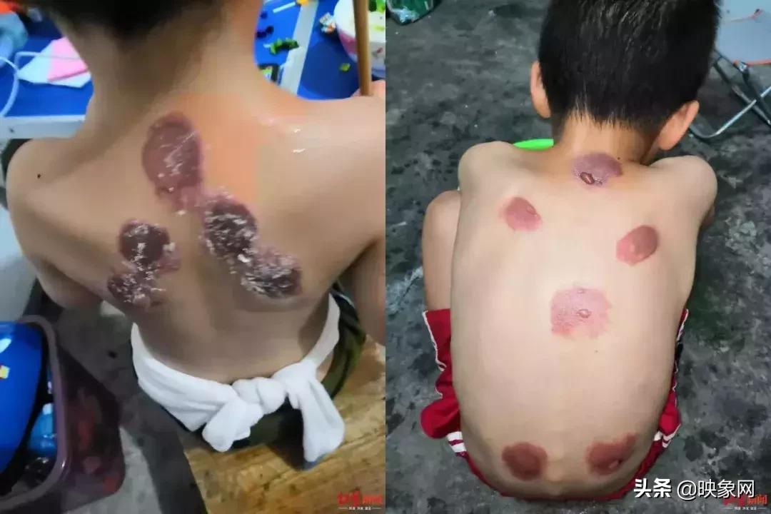 郑州三伏贴哪家好,郑州三伏贴有效吗