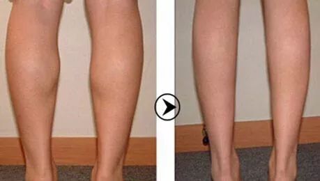 如何瘦小腿简单快速有效三个动作,腿粗怎么瘦小腿