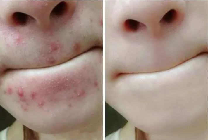 青春痘祛痘方法小妙招,青春痘快速消除方法视频