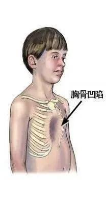 301医院胸外科漏斗胸手术,胸外科有啥新技术