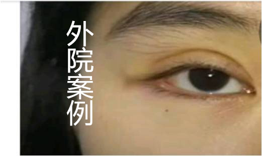 自己的双眼皮太深显老怎么修复,做的双眼皮一笑有皱纹怎么修复