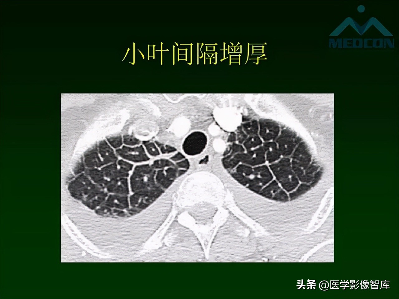 肺弥漫性网状影,两肺小叶间隔增厚可见网状模糊影