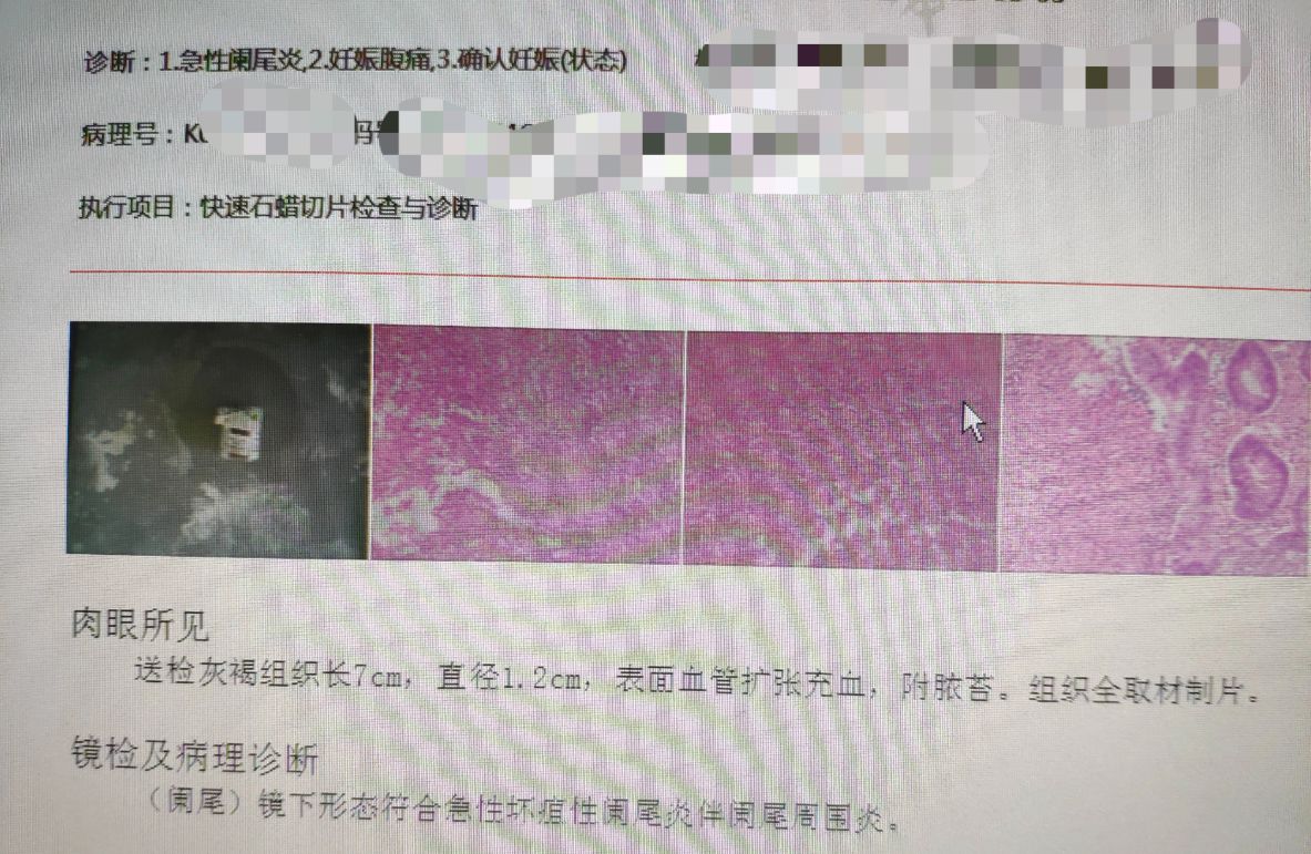 孕早期44天急性化脓阑尾炎该咋办,阑尾炎保守治疗中腹痛