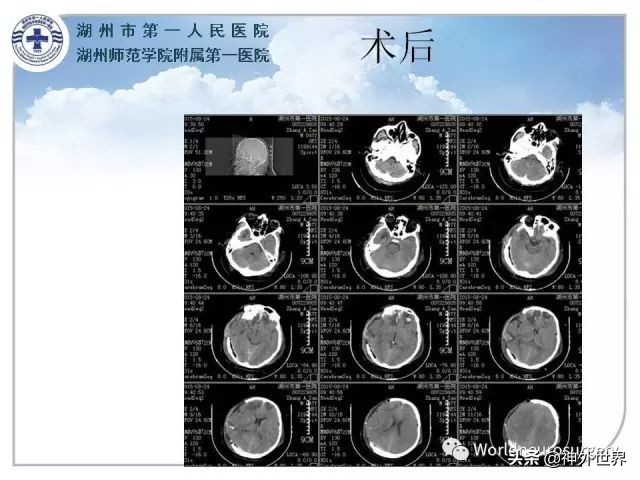 头皮裂伤缝合手术切口分类,头皮切口