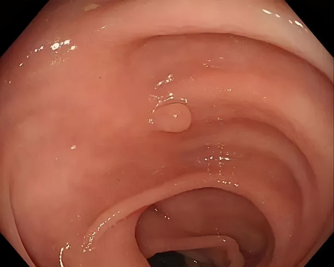 关于肠息肉你最想知道的9个问题,肠息肉术后饮食问题