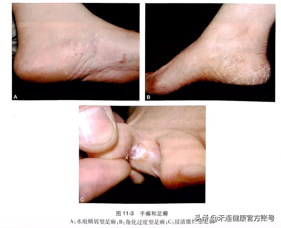 脚起水泡痒是什么脚气,脚气脚痒有水泡根治小方法