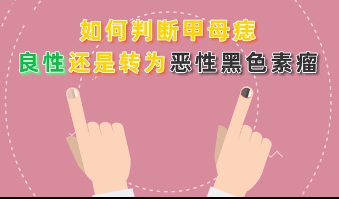 手指甲黑线怎么看是不是黑色素瘤,指甲有甲母痣会癌变吗