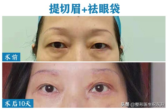 45岁上眼皮下垂的解决方法,51岁眼皮下垂怎么办