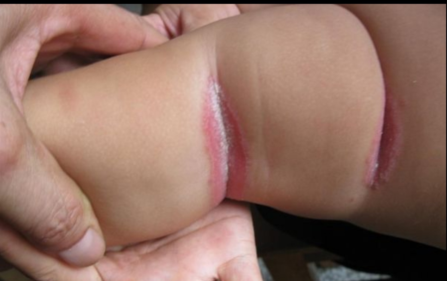 皮肤病常见菌,念珠菌性间擦疹