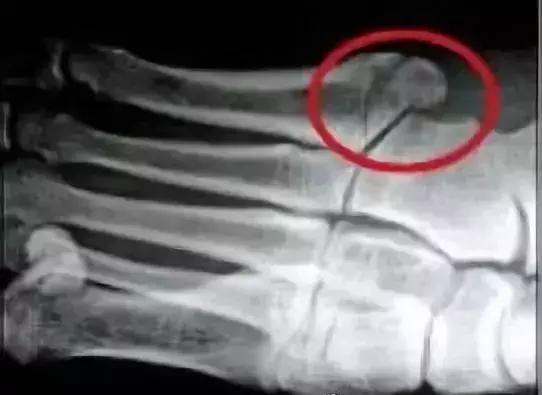 常见足球运动损伤及处理方法教案,常见的足球运动损伤的预防及治疗