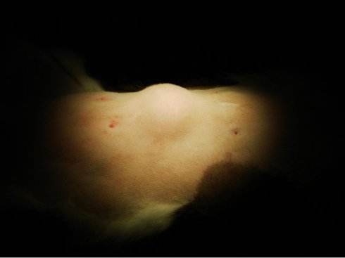 身上长了脂肪瘤要不要手术切了,身上长脂肪瘤是否需要手术治疗