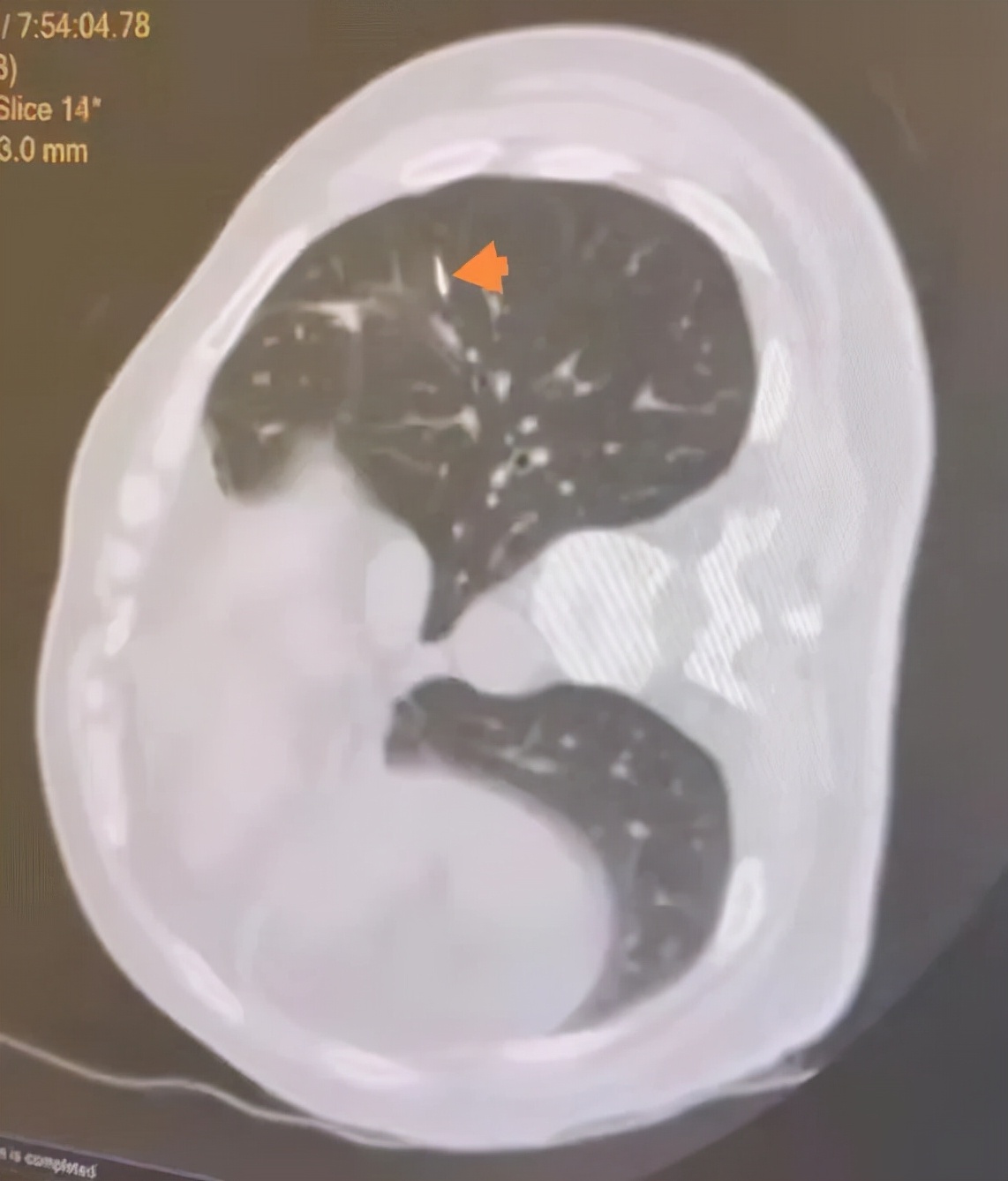 肺结节多学科联合诊疗,多学科会诊肺结节