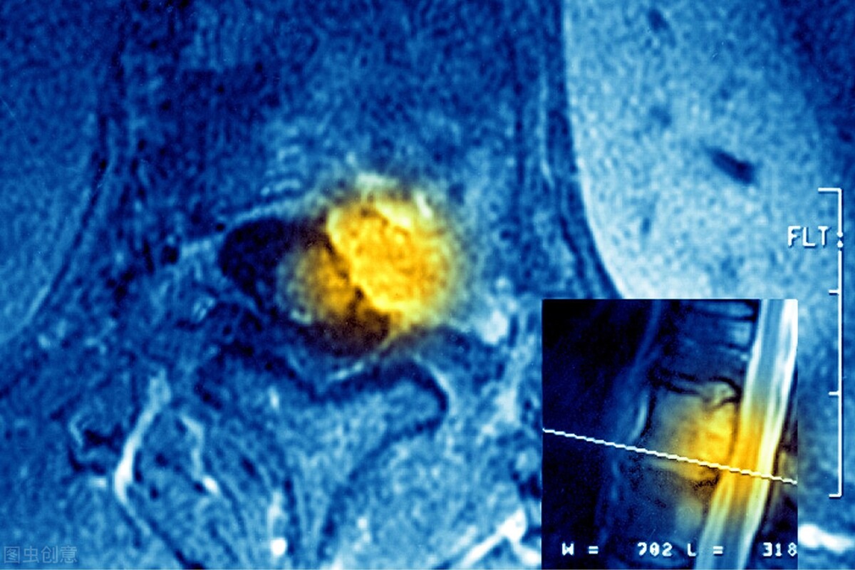 多发神经鞘瘤有什么表现吗,多发性神经鞘瘤有中药治疗吗