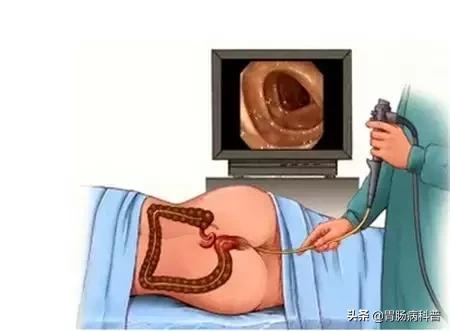 科普胶囊内镜和电子内镜该怎么选,胶囊内镜与无痛胃肠镜区别