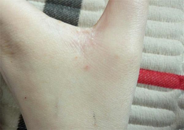 手上汗疱疹反复复发怎么办,手上汗疱疹反复发作怎么办